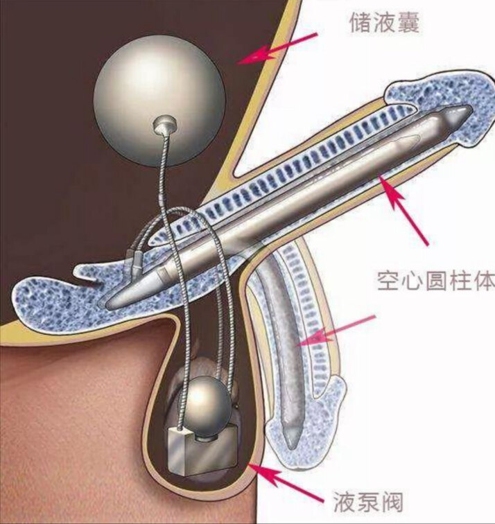 包含男性勃起功能障碍科普的词条-第2张图片-印淘网